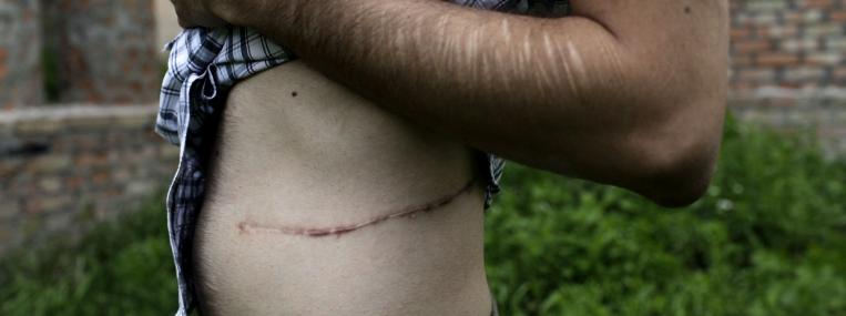 In Ukraine, Renat Abduliu displays the scar left after he sold one of his kidneys on the international black market in 2011 for $10,000. (DIANA MARKOSIAN / REDUX)